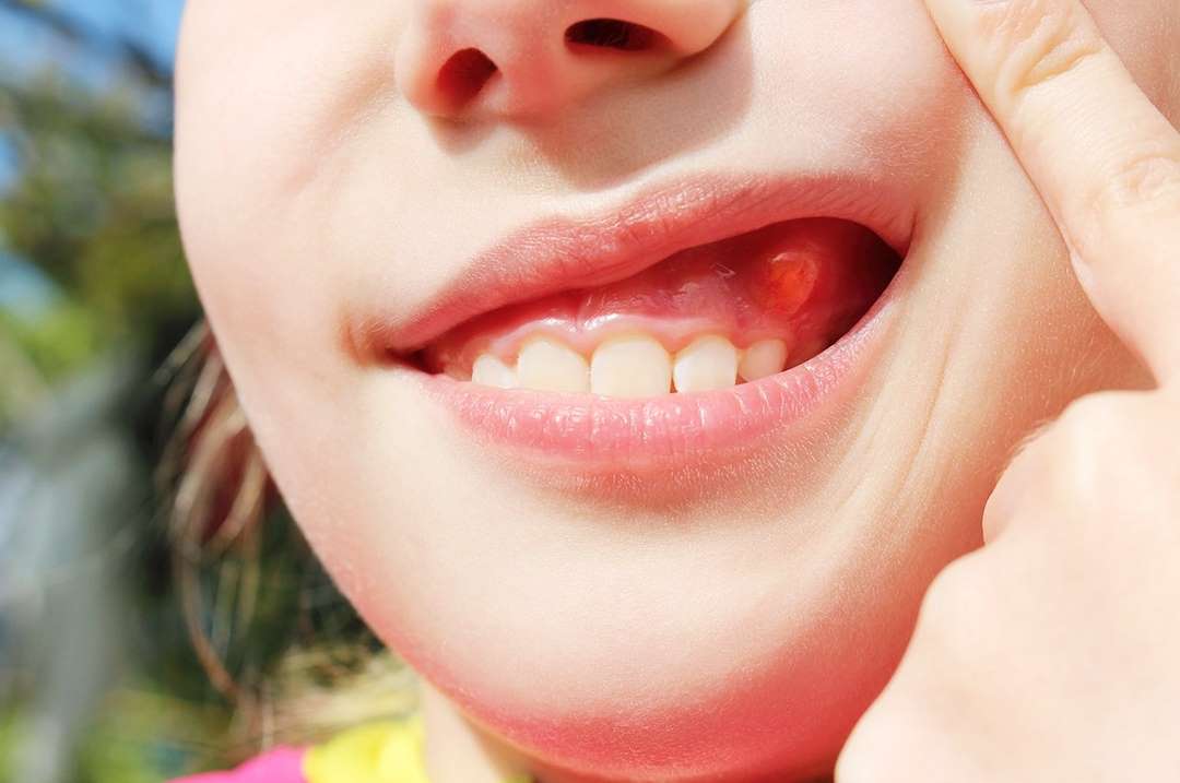 Loại bệnh này có thể xuất hiện ở vùng răng
