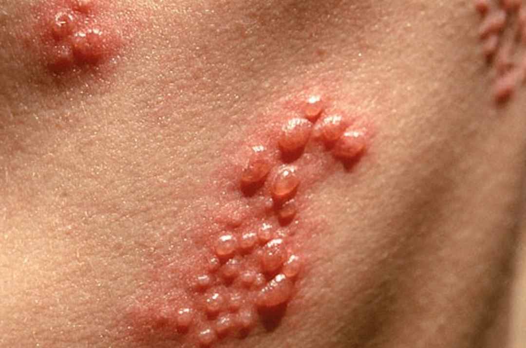 Bệnh giời leo gây ra nhiều nốt mụn trên bề mặt da