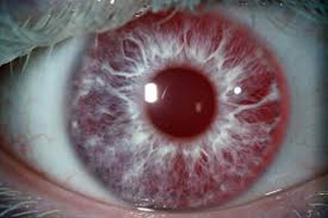 Bệnh có thể dẫn đến những sự thay đổi về mắt