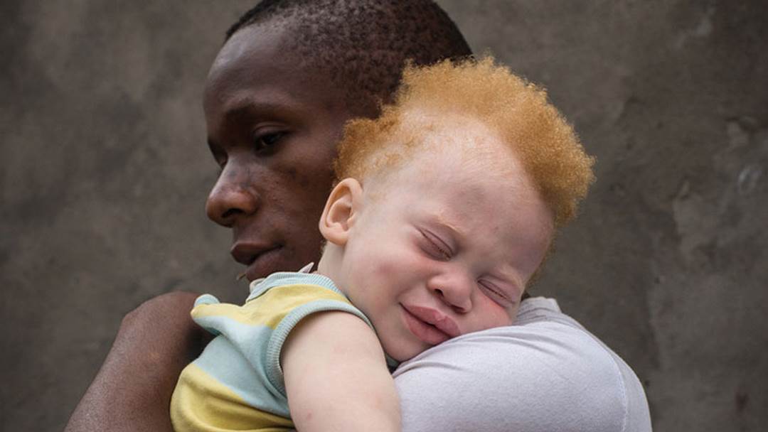 Đứa trẻ Châu Phi ra đời bị bạch tạng khiến màu da và màu tóc thay đổi