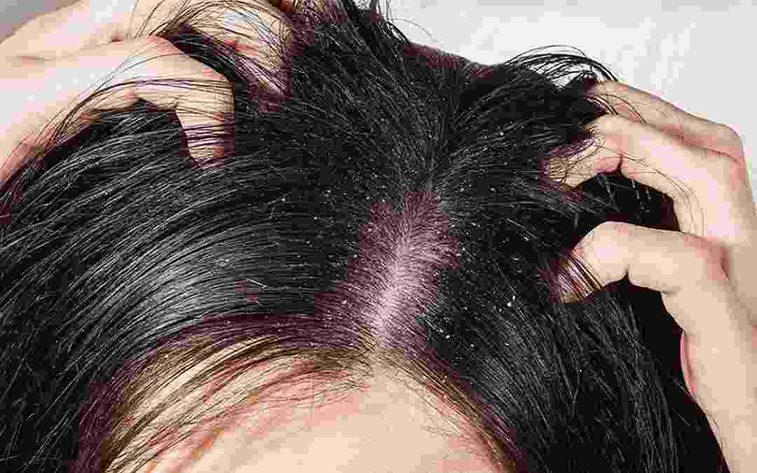 Nấm da đầu gây khó chịu cho người bệnh