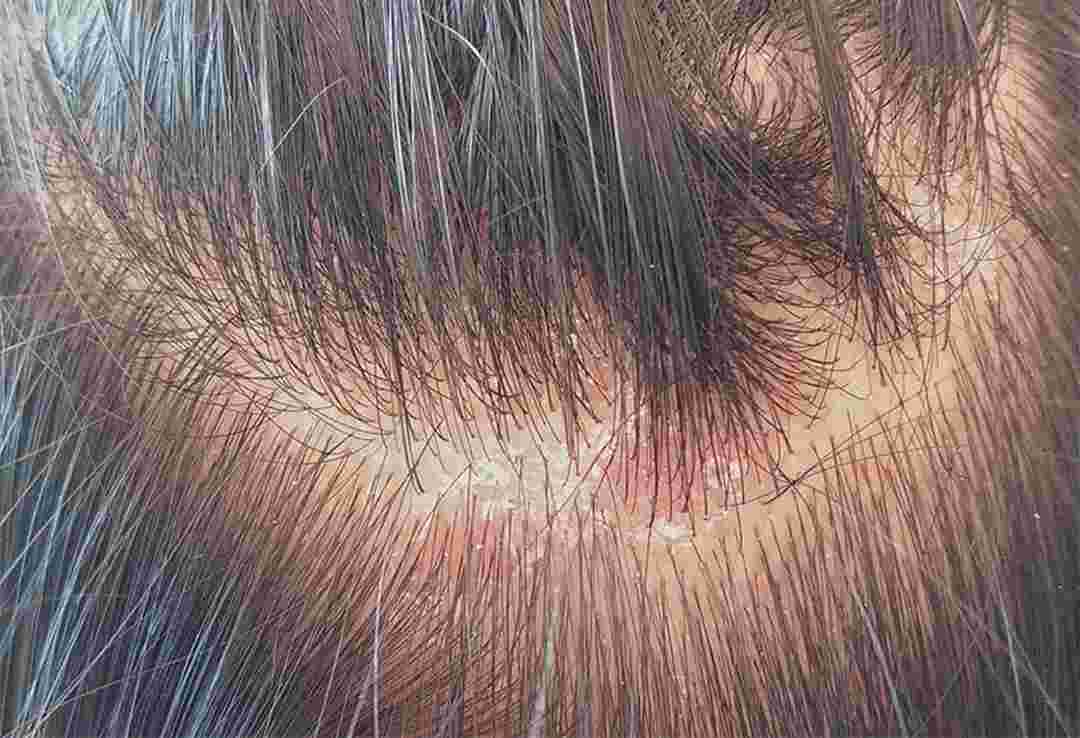 Các mảng bám da đầu xuất hiện khi mắc bệnh