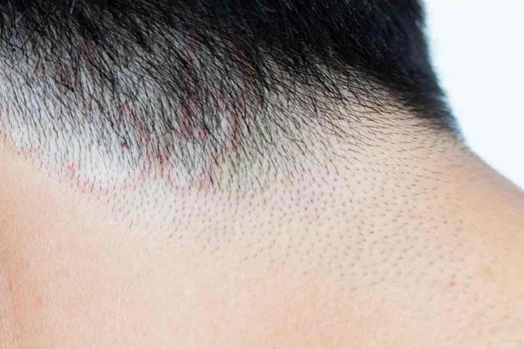Bệnh nấm ở vùng da đầu và phương pháp điều trị hiệu quả
