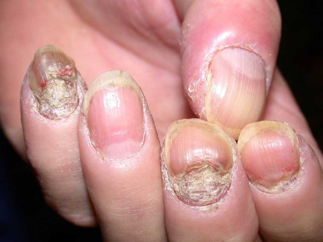 Nấm móng tay rất dễ tái đi tái lại trên người bệnh
