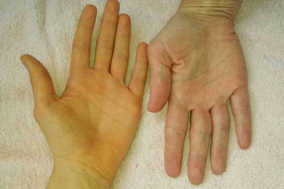 Bàn tay người mắc bệnh sẽ chuyển màu vàng hơn