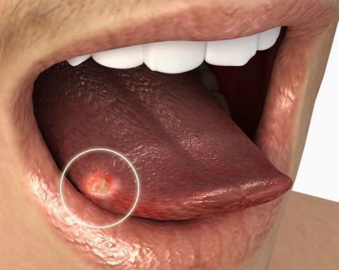 Ung thư vùng lưỡi giai đoạn tiến triển