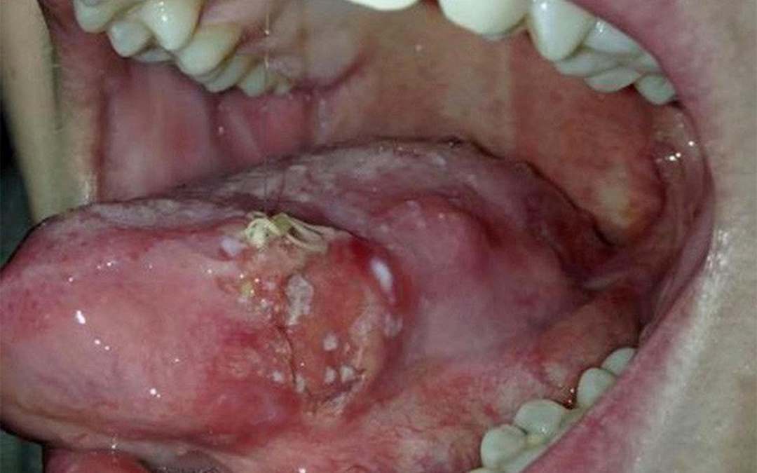 Các phương pháp có thể chữa trị ung thư vùng lưỡi nặng
