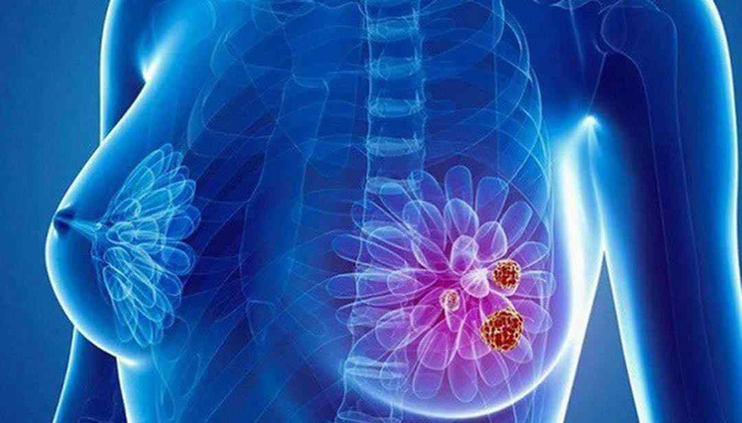 Bệnh ung thư vú - Breast cancer - U vú ác tính