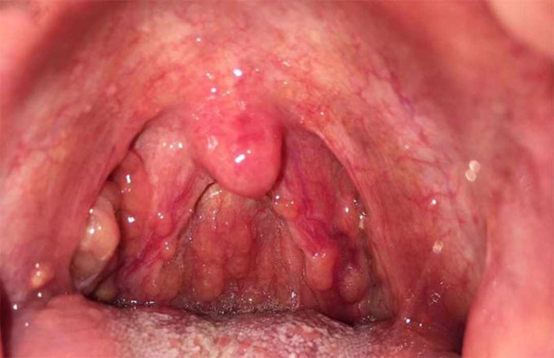 Viêm họng hạt là loại bệnh như thế nào?