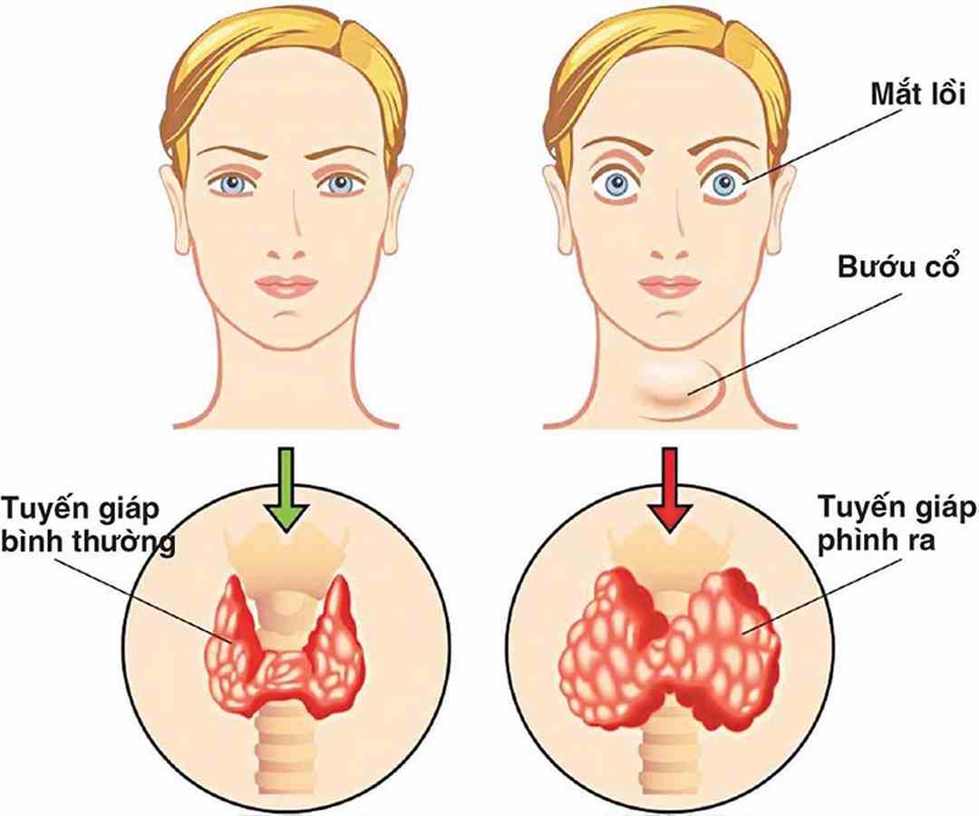 Bướu cường giáp basedow là một trong những dạng bệnh gặp nhiều nhất hiện nay