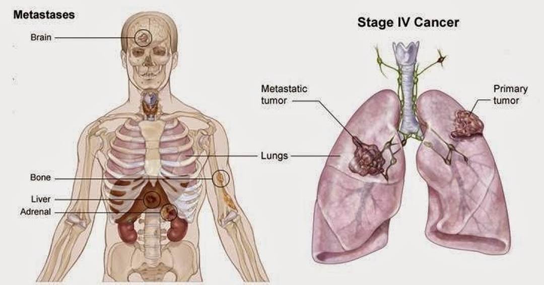 Ung thư phổi di căn xương thường gặp ở giai đoạn 3 - 4