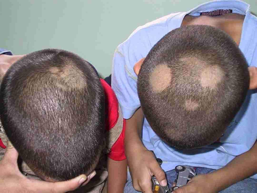 Bệnh nấm da đầu là bệnh nấm da phát sinh ở da đầu, tóc.