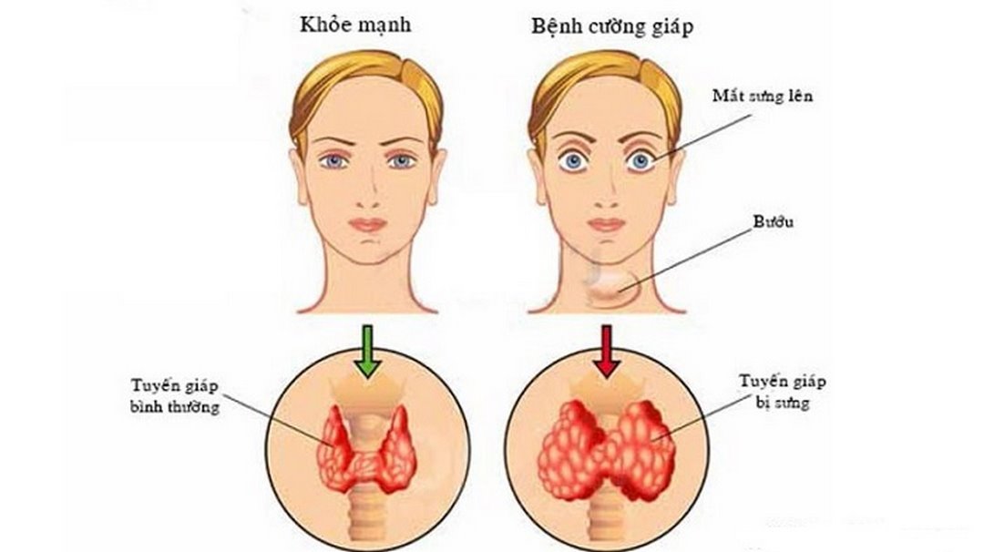 Bệnh cường giáp (hình ảnh minh họa)