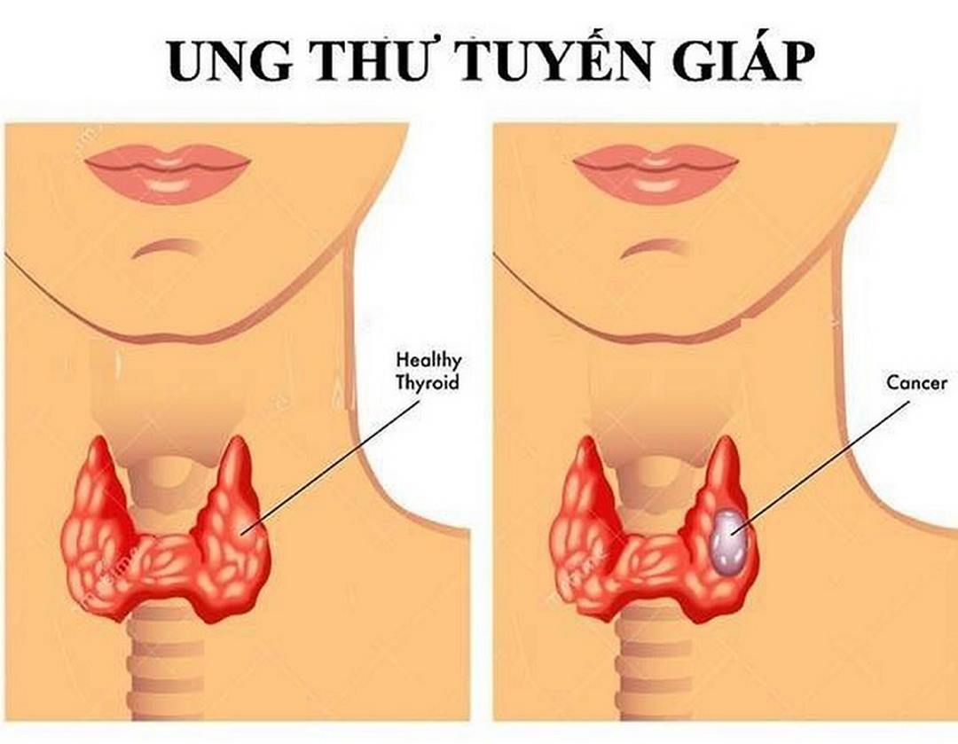 Ung thư tuyến giáp