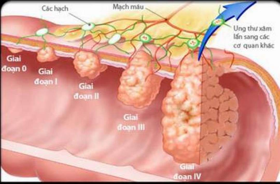 Các giai đoạn của ung thư dạ dày