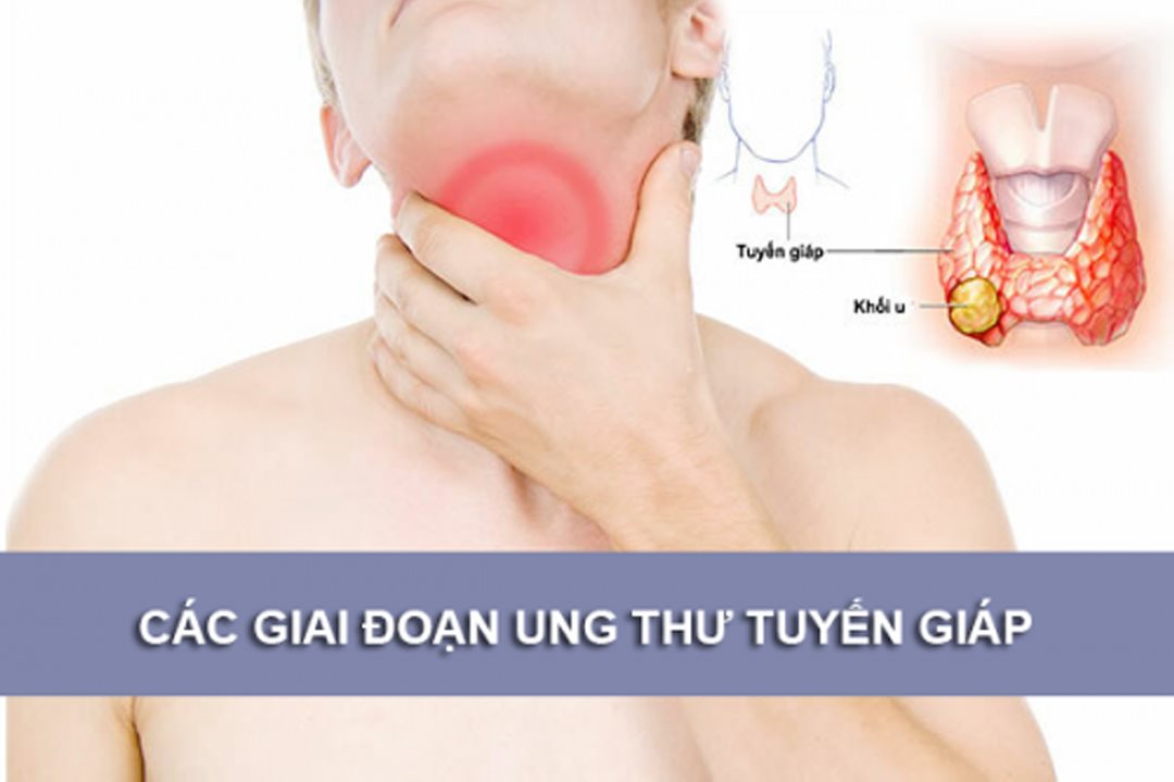 Ung thư tuyến giáp gồm mấy giai đoạn