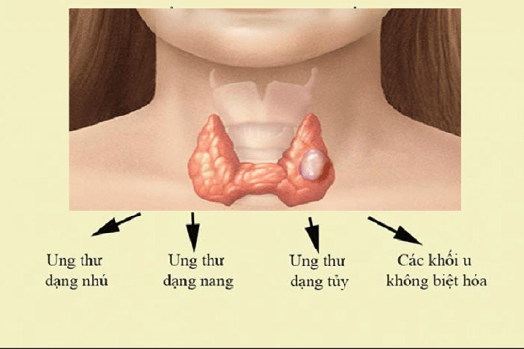 Các giai đoạn sẽ có triệu chứng khác nhau