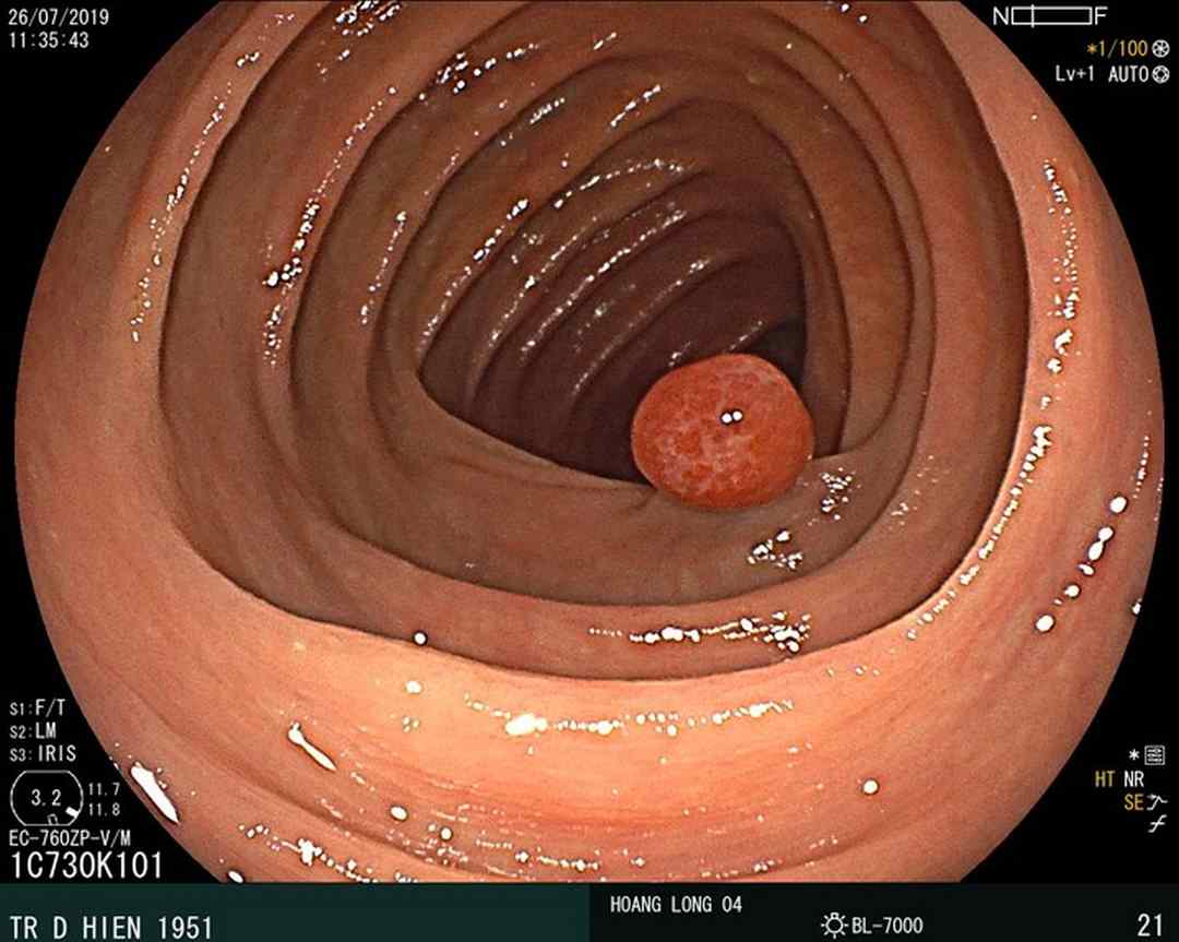 Hình ảnh polyp đại tràng phát hiện trong quá trình nội soi