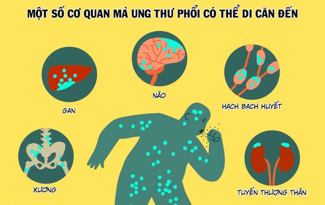 Ung thư phổi ảnh hưởng tới các cơ quan khác