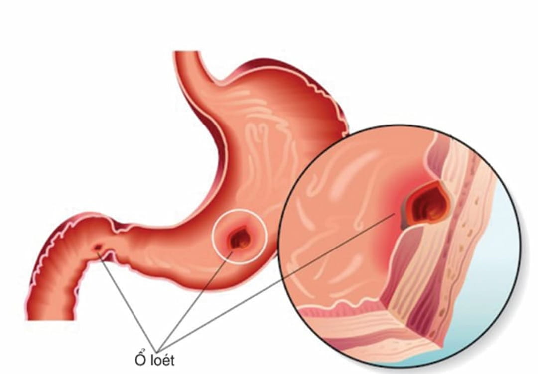 Bệnh đau dạ dày xuất phát từ các vết loét ở lớp niêm mạc