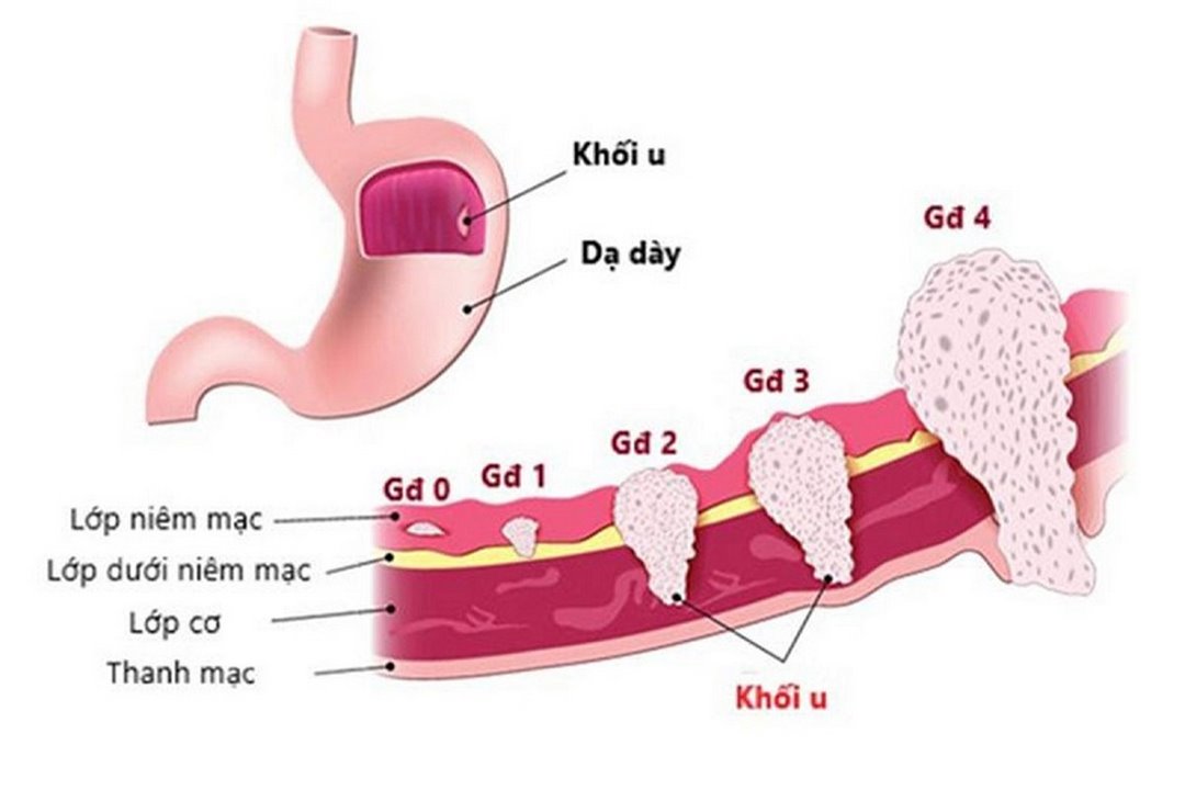 Các giai đoạn tiến triển của bệnh ung thư dạ dày