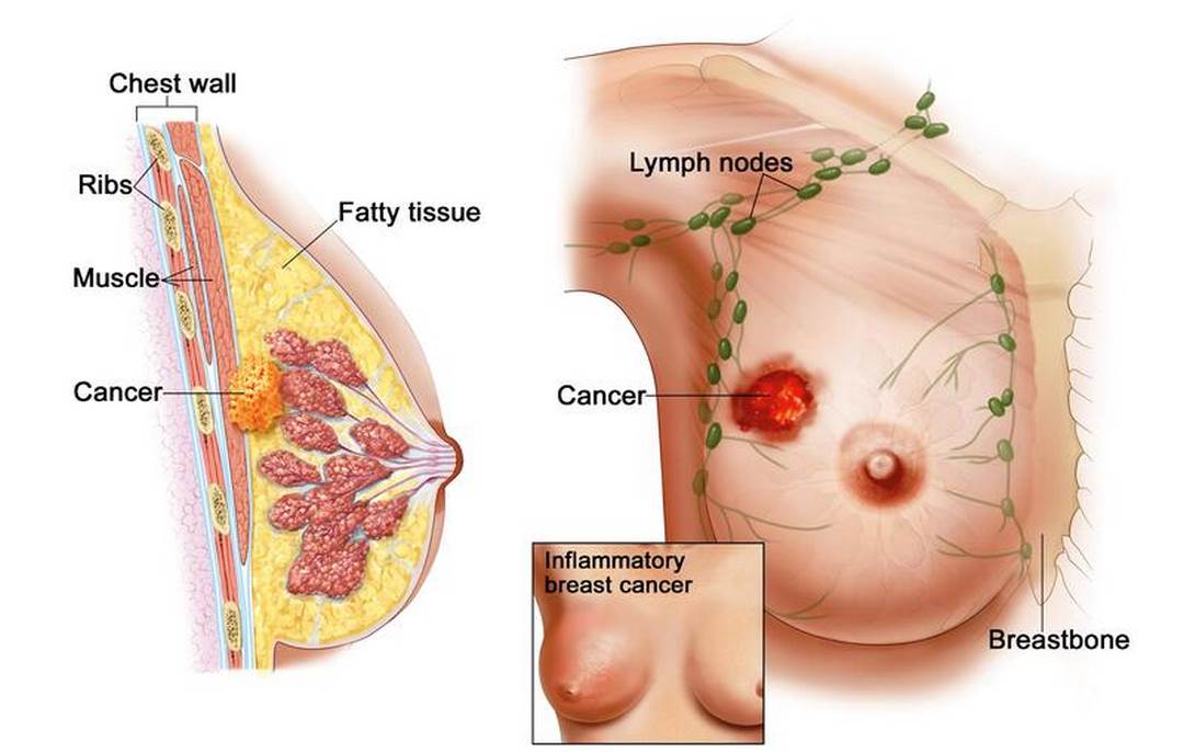 Đau vú kéo dài không liên quan đến chu kỳ kinh nguyệt cần kiểm tra sớm