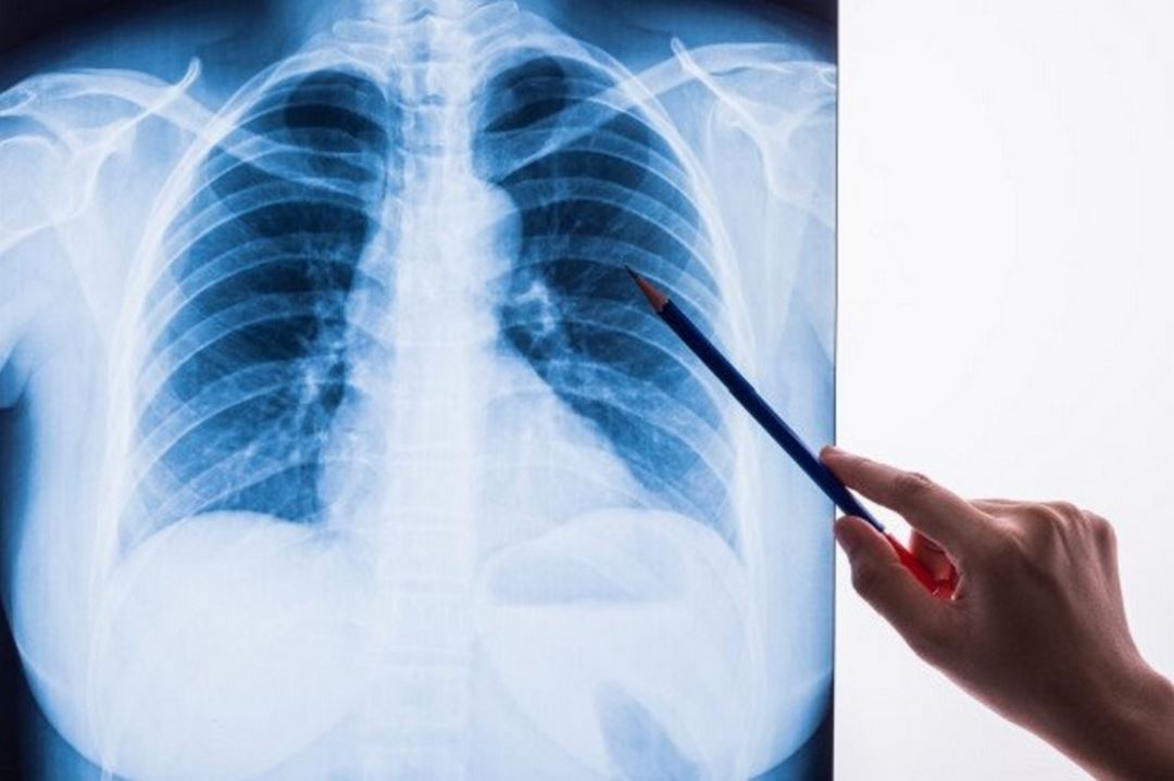 Ung thư phổi được phát hiện qua chụp X quang