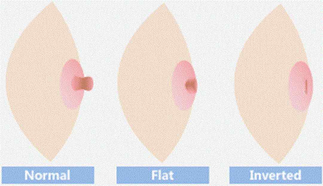 Nguyên nhân núm vú bị thụt vào bên trong