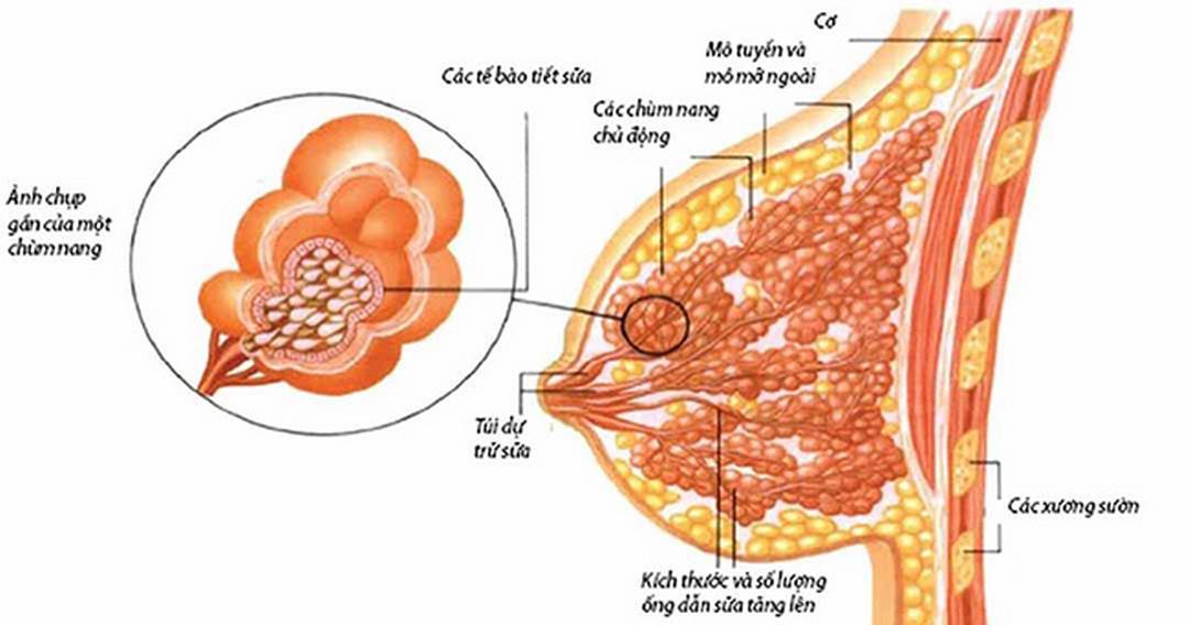 Cục cứng ở vú có thể là bệnh u nang tuyến vú