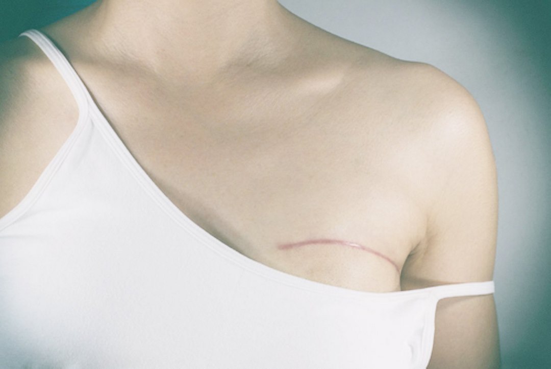 Phẫu thuật bảo tồn vú là phẫu thuật cắt bỏ khối u, cắt bỏ một phần tuyến vú