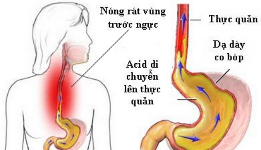 Hình ảnh trào ngược axit.