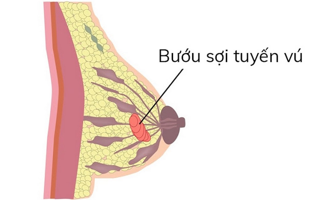 Có nhiều loại u vú lành tính với các biểu hiện bệnh lí riêng biệt.