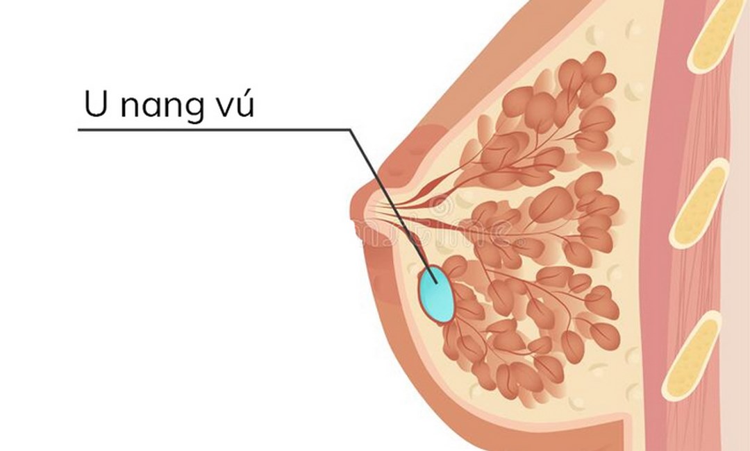 U nang vú thường không gây bất kì đau đớn hay khó chịu nào (Ảnh minh họa)