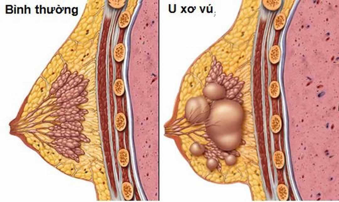 U xơ tuyến vú là dạng tổn thương lành tính nhưng có thể gây khó chịu cho một số phụ nữ