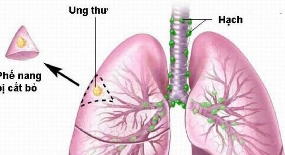 Ung thư phổi di căn hạch ở cổ là giai đoạn cuối của bệnh ung thư