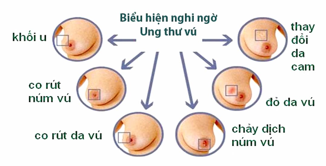 Các triệu chứng của bệnh ung thư vú phổ biến