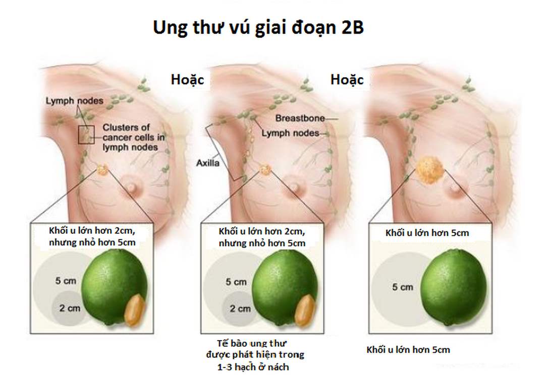 Ung thư vú giai đoạn 2B