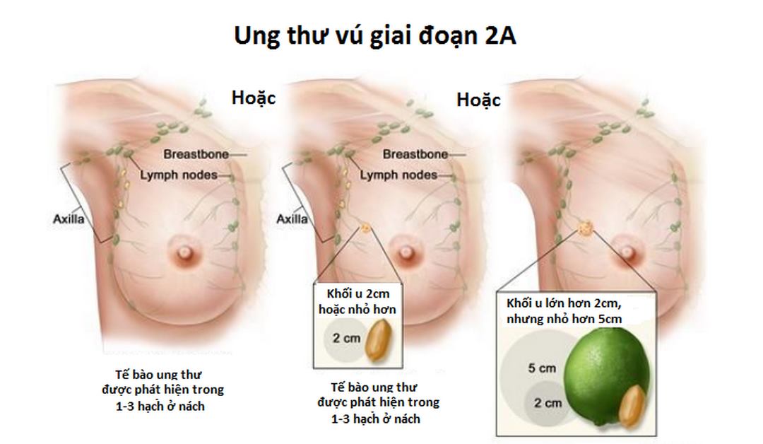 Ung thư vú giai đoạn 2A