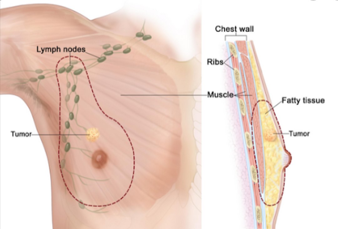 Núm vú co rúm là dấu hiệu ung thư vú ở nam giới