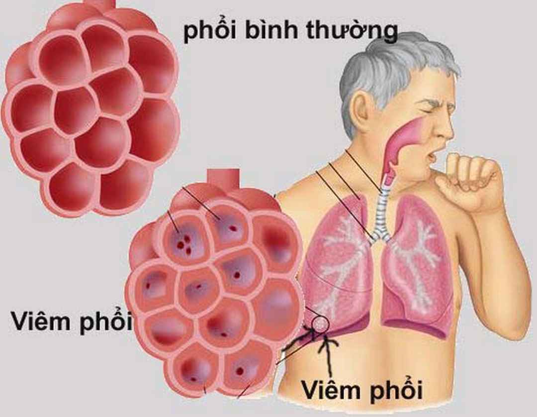 Hình ảnh phổi bình thường và phổi bị viêm ở người cao tuổi