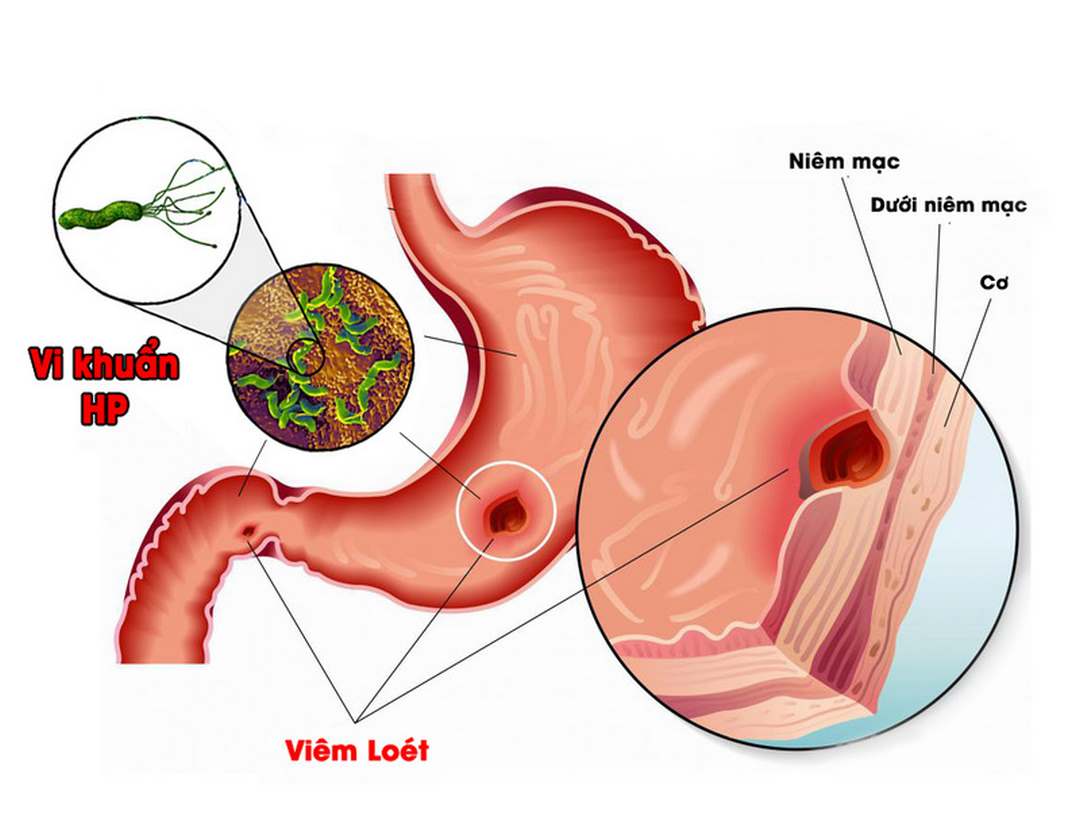 Viêm loét dạ dày tá tràng là nguyên nhân hàng đầu