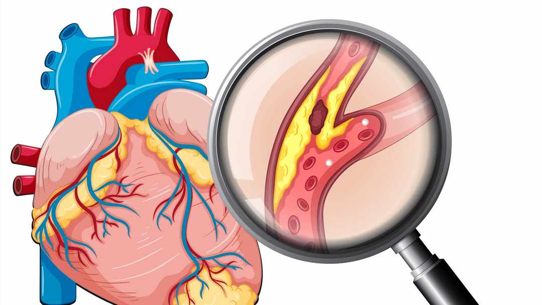 Các bệnh nền về bệnh lý tim mạch phổ biến