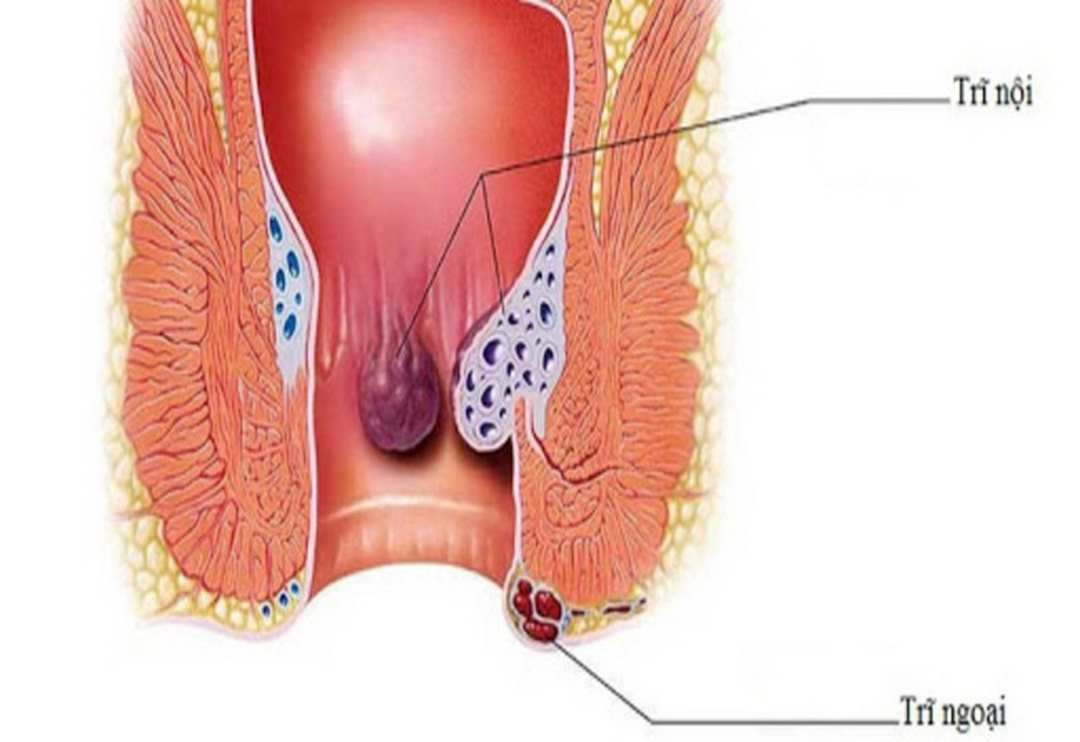 Táo bón lâu ngày có thể gây bệnh trĩ