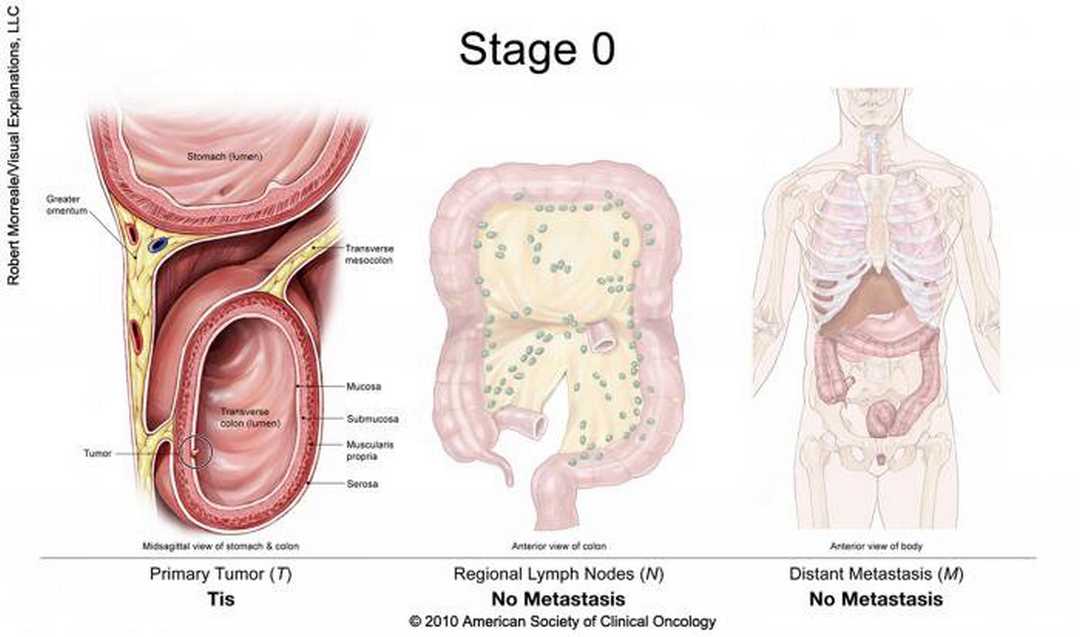 Ung thư đại tràng giai đoạn 2