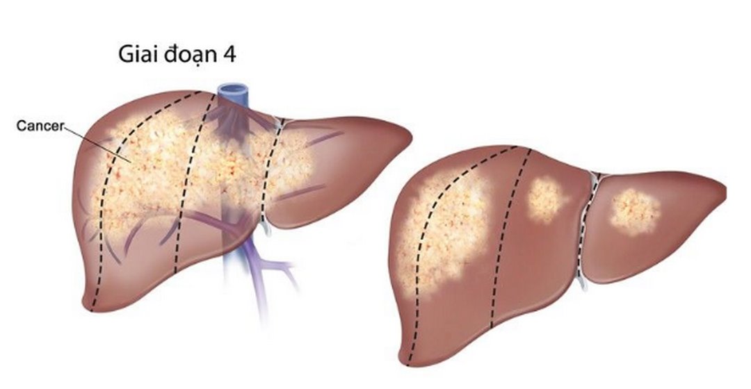Ở giai đoạn 4 ung thư gan có dấu hiệu di căn tới các cơ quan khác trên cơ thể