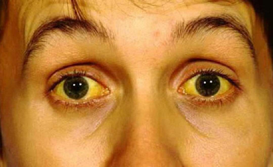Bệnh nhân ung thư gan di căn có biểu hiện vàng da, vàng mắt