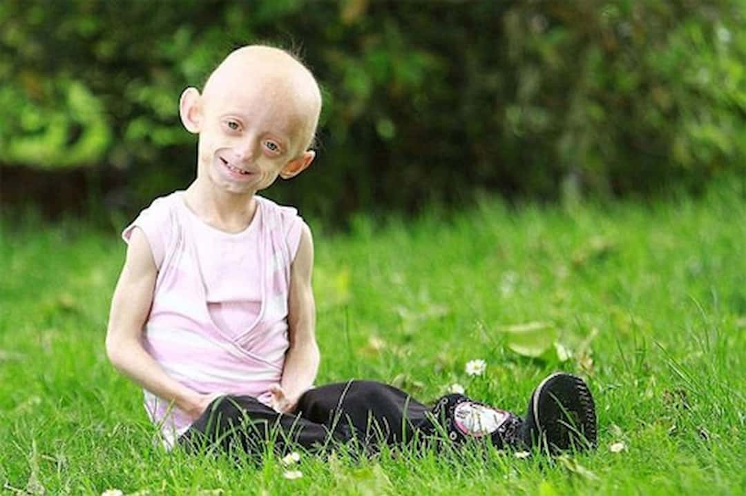 Progeria khiến đứa trẻ 10 tuổi trông như cụ già 80 tuổi