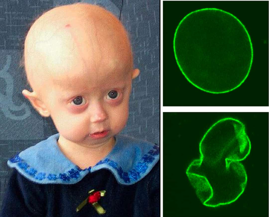 Hội chứng Progeria