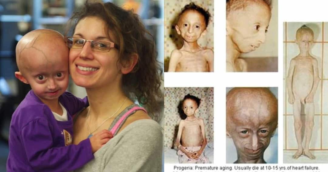 Progeria có di truyền không?