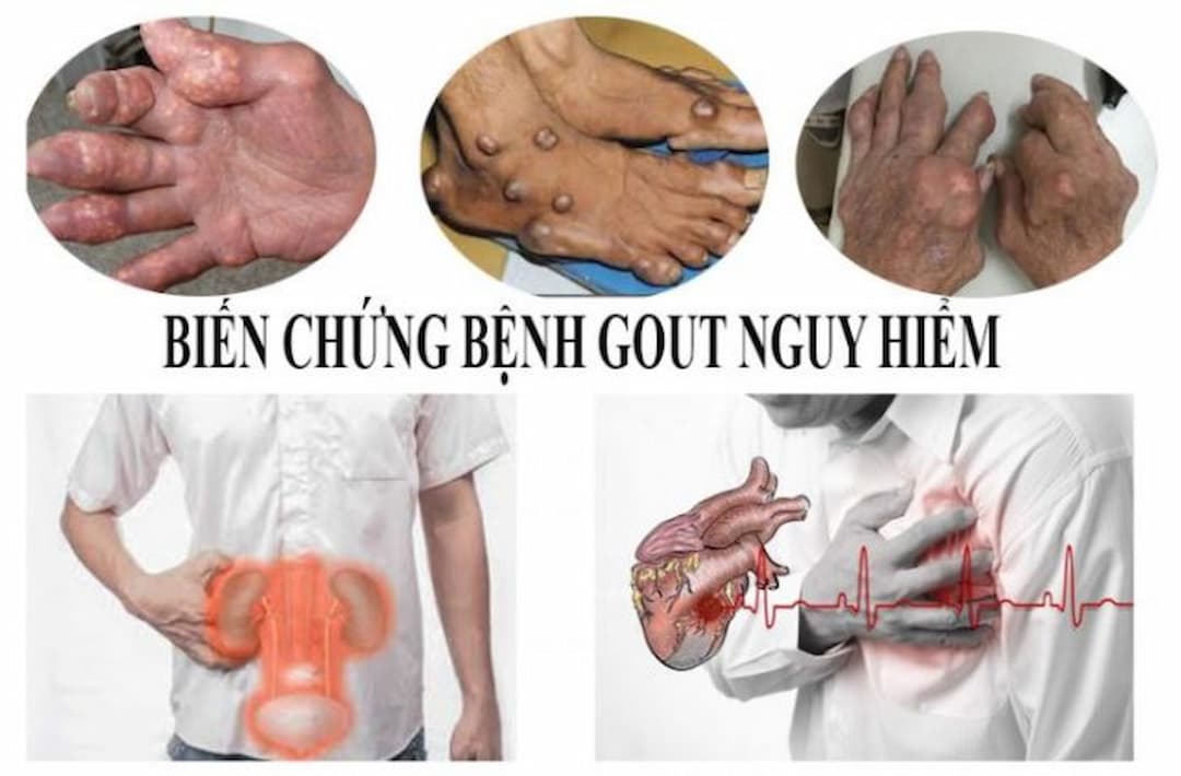Bệnh gout có thể gây ra nhiều biến chứng nguy hiểm cho người bệnh